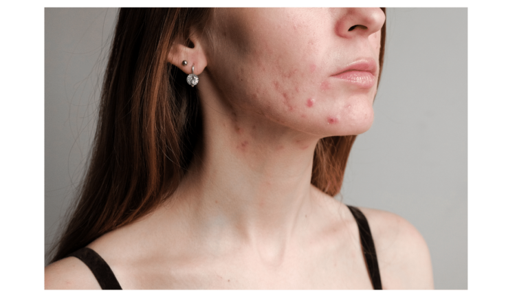 Understanding and Managing Hormonal Acne at Any Age