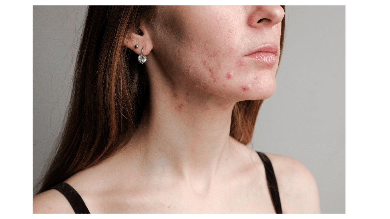 Understanding and Managing Hormonal Acne at Any Age